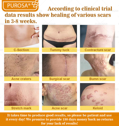 PUROSA® Bee Venom Skin Treatment Cream, Anti-aging, Hydrating, Skin Repair, Even Tone, Acne and Dark Spot Treatment, Wart and Mole Removal, Psoriasis Relief