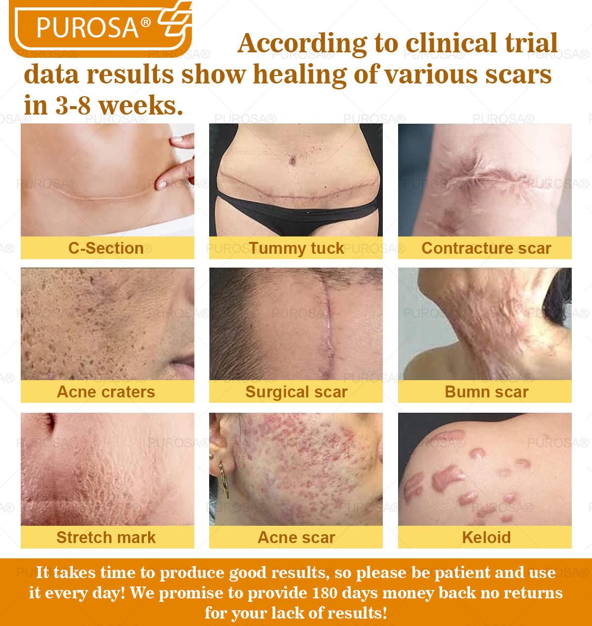 Limited to 10 jars! 🌟PUROSA®—Exclusive 30% discount, restore your skin's youthful glow in just 1-3 weeks! A rare opportunity — won’t be available again until next year, don’t miss out!180-day money-back guarantee, full refund with no risk!